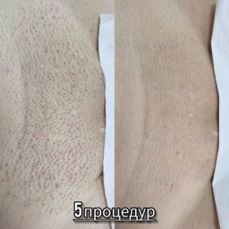 Эпиляция с диодным лазером 2026 года требует не только мощности но и точной фазы подачи